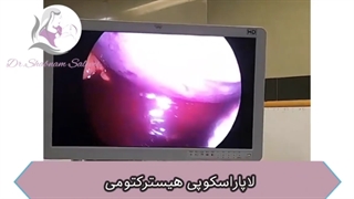 لاپاراسکوپی هیسترکتومی