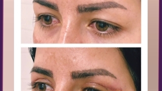 هزینه برداشتن پف بالای چشم