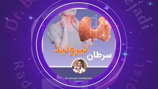 سرطان تیروئید