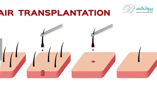 کاشت مو به روش  FIT و نکاتی که در مورد آن باید بدانید | بیوتکس