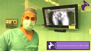 درمان لنگش در اطفال