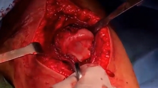 جراحی استخوان بازو