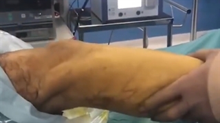 بازسازی رباط صلیبی