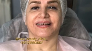 رفع خط خنده با نخ کلاژن ساز # 09120660447