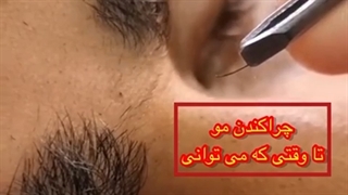 چرا کندن مو