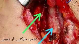 فیلم جراحی تیروئید