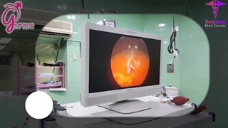 عمل آندوسکوپیک سنگ مثانه