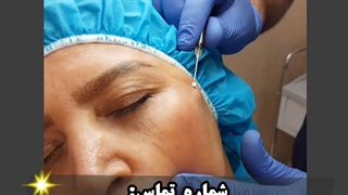 لیفت صورت با نخ