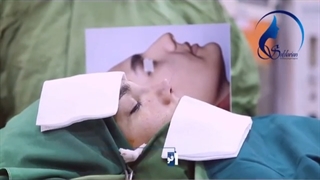 جراحی انحراف بینی و اصلاح آن
