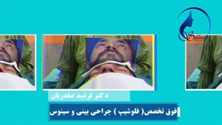 جراحی زیبایی بینی با انحراف شدید