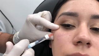 آموزش تزریق ژل زیر چشم