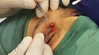 عمل تومور چشم همراه بلفاروپلاستی