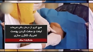 لیفت با نخ آپتوس