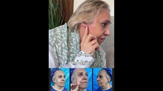 رضا امرأة تبلغ من العمر 75 عامًا عن عملیة شد الوجه