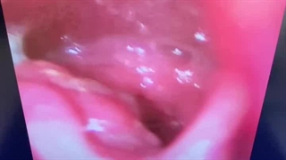 سرطان حنجره در جوان ۴۷ ساله روزی ۳ پاکت سیگار