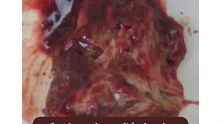 درمان کیست تخمدان و رحم با گیاهان دارویی [بدون عوارض]