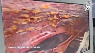 برداشت لاپاروسکوپی کیسه صفرای باقیمانده به علت وجود سنگ در کیسه صفرای باقیمانده پس از کوله‌سیستکتومی ساب توتال.