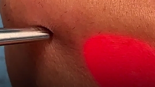 کاری که لیزر سایناشور با موهای زائدت میکنه